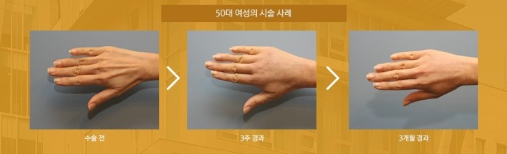 세월의 흔적을 감추는 매끈한 손등! JW정원성형외과 손등지방이식 관련 이미지 7