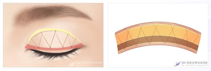 크고 아름다운 나만의 맞춤 쌍꺼풀! JW정원성형외과 쌍꺼풀수술 관련 이미지 4