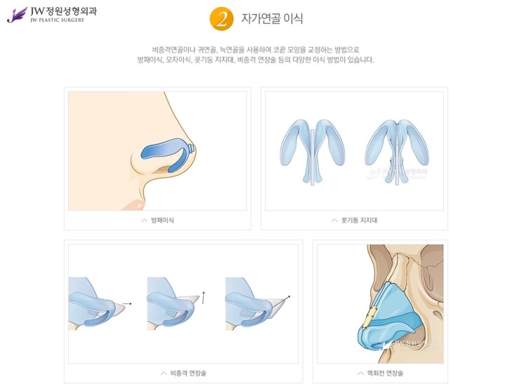 [JW정원성형외과] 코끝성형비용 보다 중요한건 코끝성형결과! 관련 이미지 6