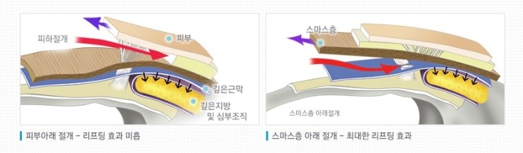 [JW정원성형외과] 안면거상술로 동안완성! 안면거상잘하는병원 관련 이미지 3