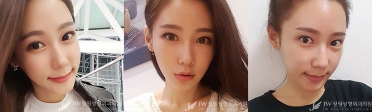 [JW정원성형외과] 턱끝재수술, 비절개눈매교정으로 동안 완성♡ 리얼셀카 관련 이미지 5
