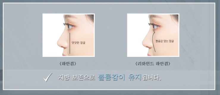 내 인상 그대로, 10년 전으로 돌아가는 JW정원성형외과 리와인드 하안검 관련 이미지 8