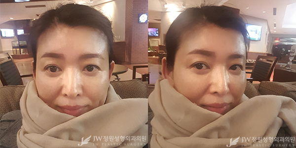 세월의 흔적 JW정원성형외과 이마눈썹거상+리와인드하안검으로 말끔하게♡ 관련 이미지 5