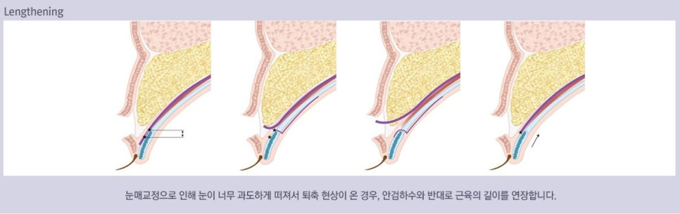 Ptosis Double Eyelid Surgery: Different Eye-Correction Methods Depending on the Degree image 7