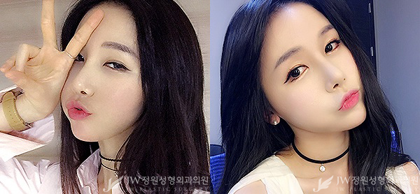 매끈한 콧날과 완벽브이라인 ▶ JW정원성형외과에서!!! 관련 이미지 3