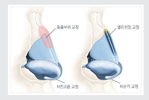 Hump Nose Diagnosis, for a More Natural Appearance image 2