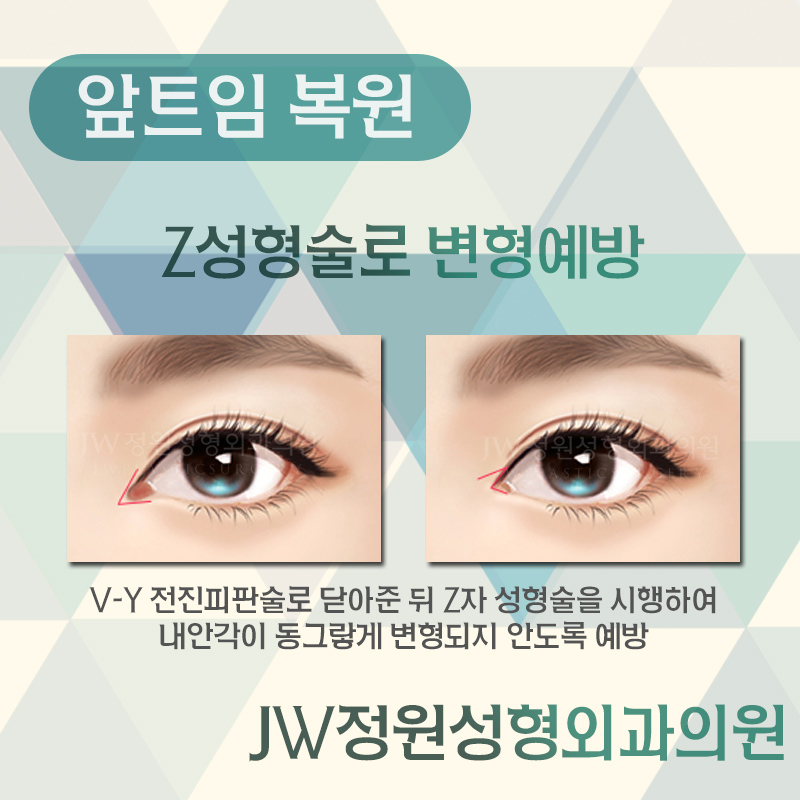과도한 앞트임, 앞트임재수술, 앞트임복원 잘 하는 병원에서 관련 이미지 4