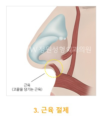 강한 인상을 부드럽게, JW정원 화살코/긴코 성형 관련 이미지 6