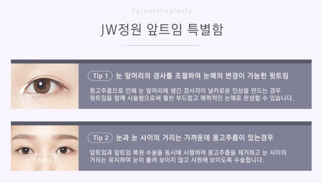 작고 답답한 눈매를 크고 시원스럽게! JW정원성형외과 360° 멀티트임 관련 이미지 3