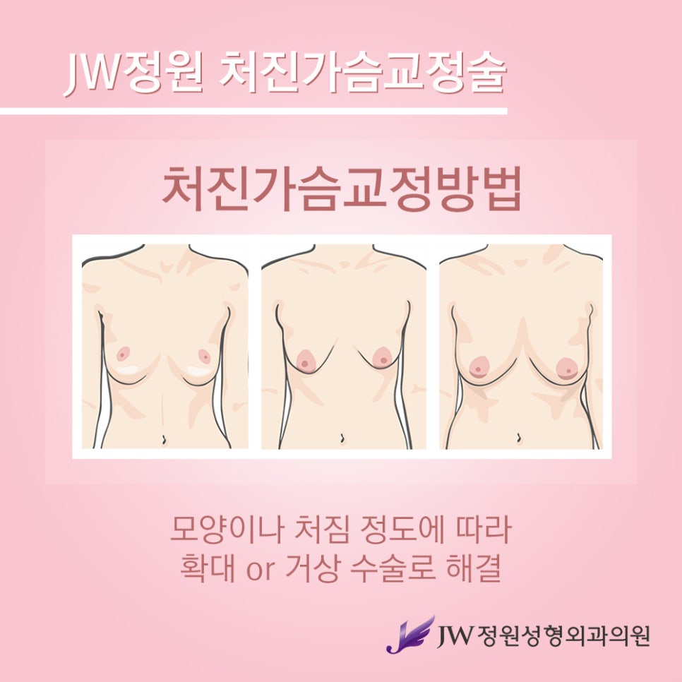 [JW정원성형외과] 처진가슴교정으로 자신감 회복! 관련 이미지 4