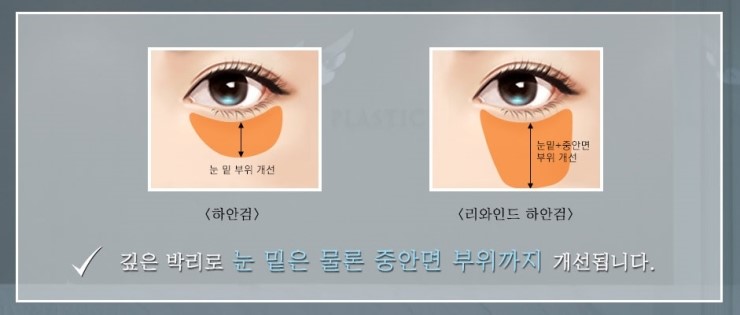 JW Garden Lower Blepharoplasty to Meet the Younger Me Again image 6