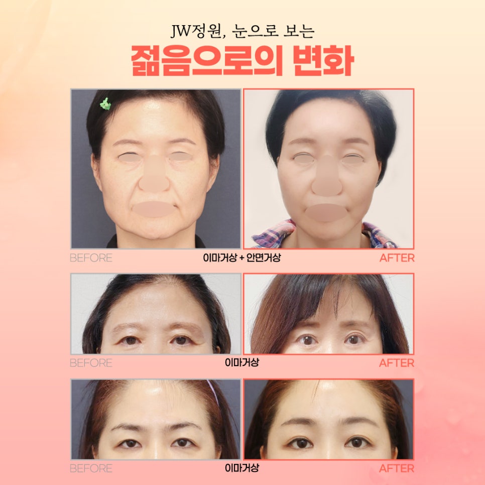 Mother’s Day Event: A Second Spring for Your Parents 【Gangnam JW Jeongwon Plastic Surgery】 image 5