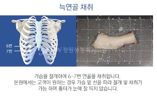 자연스러운 콧대! 견고한 코끝! JW정원성형외과 늑연골 코성형 관련 이미지 4