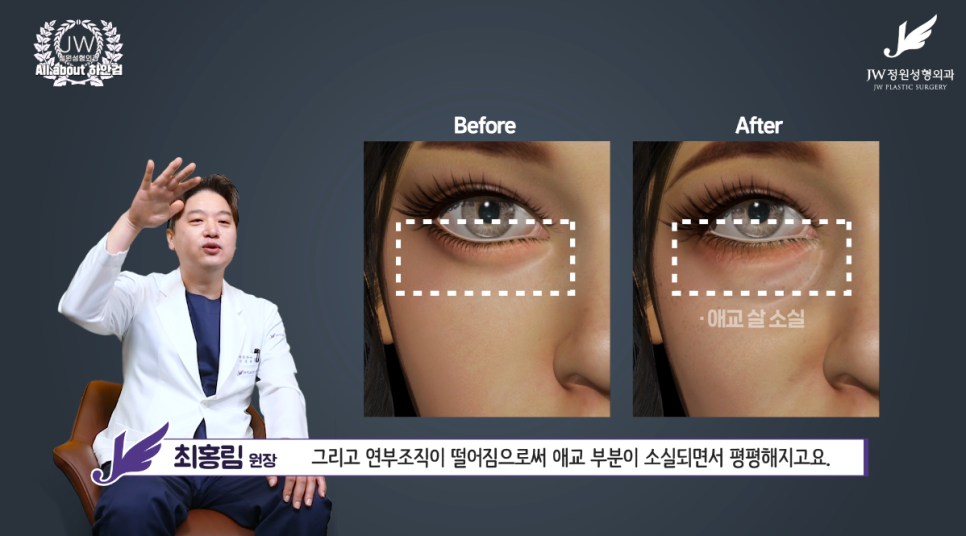 강남하안검수술 눈밑노화 개선하기 위해  【JW정원성형외과】 관련 이미지 4