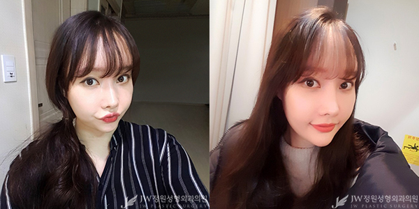 JW정원성형외과 자가지방이식으로 아름다움 완성♥ 관련 이미지 2