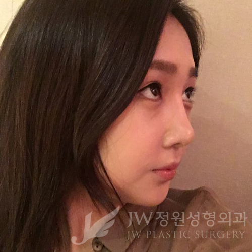 JW정원성형외과에서 매몰쌍꺼풀,앞트임,듀얼트임,코성형,넥리프팅으로 여신효과♡ 관련 이미지 14