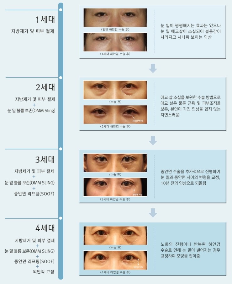Three-Dimensional Under-Eye Contours Can Be Restored to How They Looked 10 Years Ago with Lower Blepharoplasty image 5