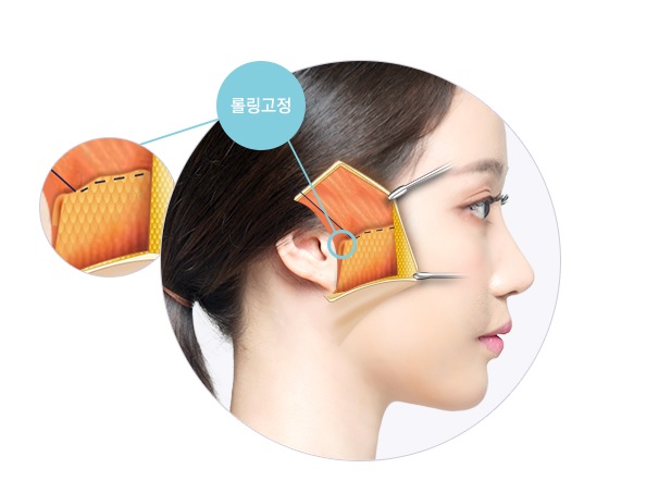 [JW정원성형외과] 안면거상술로 동안완성! 안면거상잘하는병원 관련 이미지 5