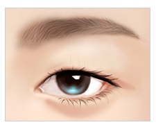 눈재수술! 병원선택부터 신중하게! JW정원성형외과 쌍꺼풀 재수술 관련 이미지 5