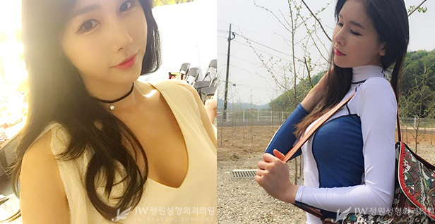 내것같은 촉감♡ JW정원성형외과 콤비네이션 가슴확대 관련 이미지 3