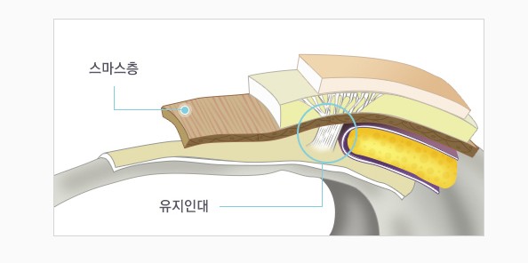 [JW정원 스마스리프팅] 꽃중년 미모의 완성, 스마스리프팅으로 관련 이미지 4