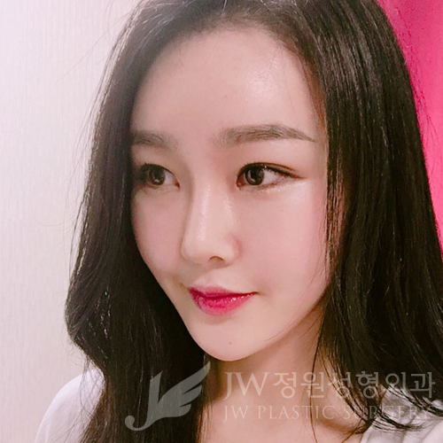 이마눈썹리프팅,눈매교정술,앞트임복원,코성형,지방이식 &rArr; JW정원성형외과에서! 관련 이미지 20