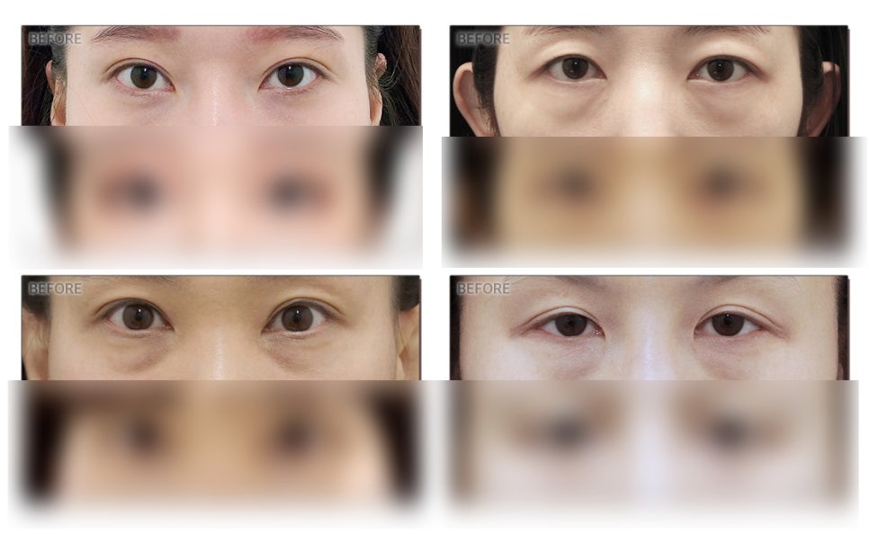 Under-Eye Hollowness: The Key Is Under-Eye Fat Treatment Technology, JW Garden Under-Eye Fat Repositioning image 2