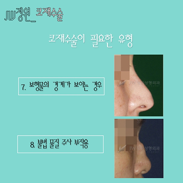 Nose revision surgery is definitely at JW Jeongwon Plastic Surgery! image 8