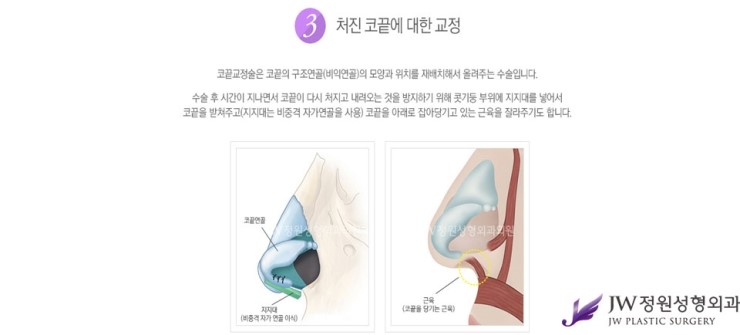 [JW정원성형외과] 매부리코성형, 매부리코성형 잘하는 곳에서 고민해결! 관련 이미지 7
