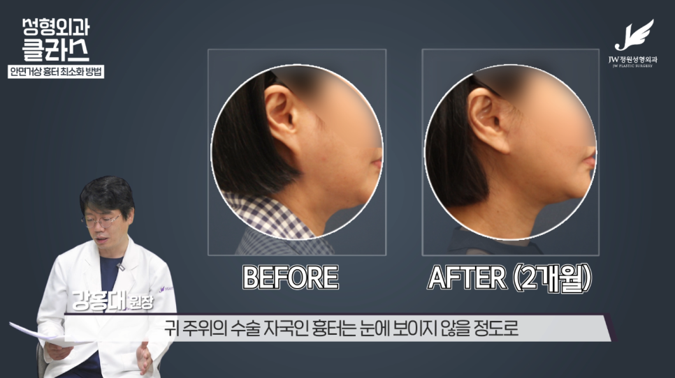 안면거상술후기 흉터 걱정 없이 깔끔하게!  【강남 JW정원성형외과】 관련 이미지 22
