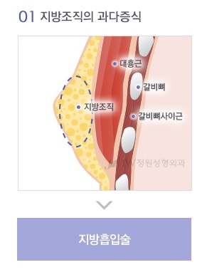 남모를 고민 여성형유방(여유증), JW정원성형외과 여성형유방 수술로 고민해결! 관련 이미지 3