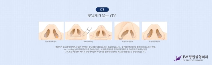 [JW정원성형외과] 촌스러운 이미지를 복코교정으로 세련되게! 콧볼축소잘하는곳에서 알아봐요 관련 이미지 8