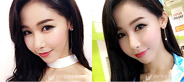 매끈한 콧날과 완벽브이라인 ▶ JW정원성형외과에서!!! 관련 이미지 6