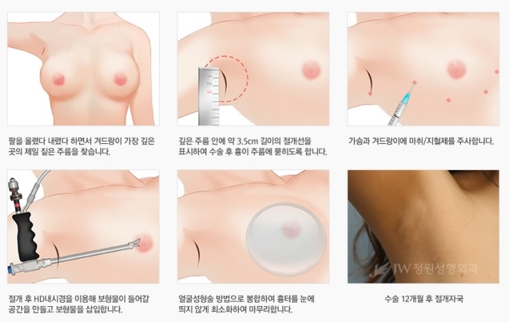 보형물+지방이식 장점만을 담은 JW정원성형외과 콤비네이션 가슴확대 관련 이미지 6