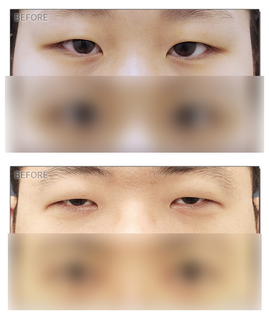 Ptosis Double Eyelid Surgery: Different Eye-Correction Methods Depending on the Degree image 3
