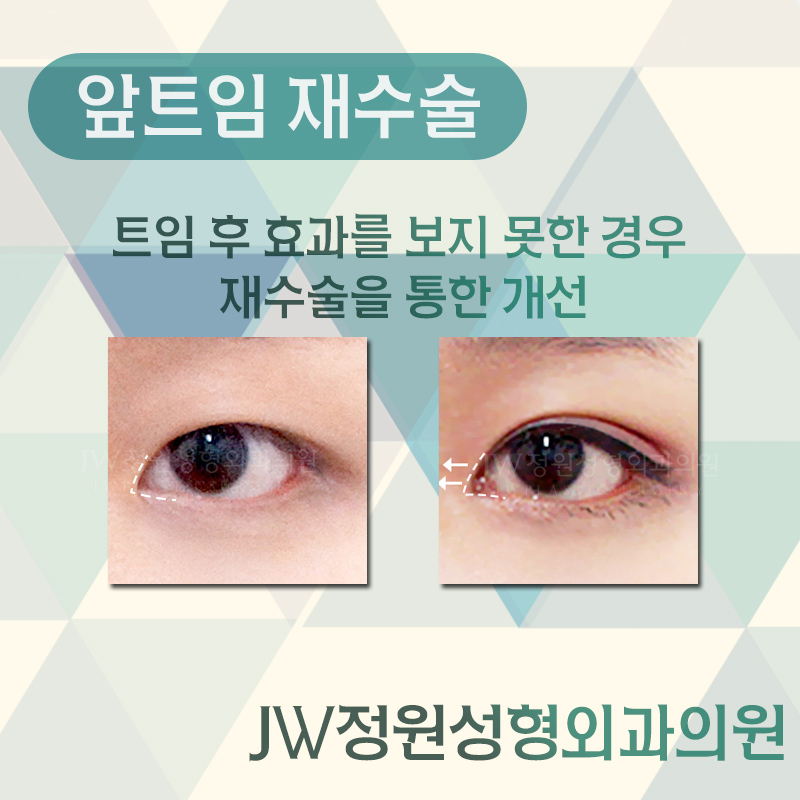 과도한 앞트임, 앞트임재수술, 앞트임복원 잘 하는 병원에서 관련 이미지 2