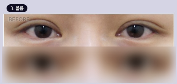 Double Eyelid Line Revision Surgery: Finding a Clinic That Is Good at Eye Revision Surgery image 4