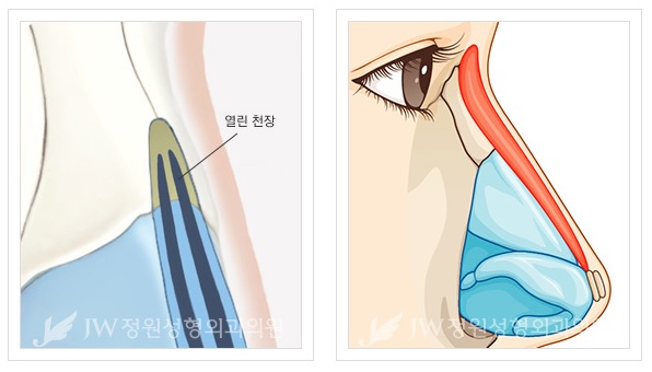 날렵하고 부드러운 이미지로! JW정원성형외과 매부리코성형 관련 이미지 3