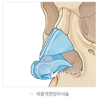 얼굴의 조화를 살린 JW정원성형외과 들창코, 짧은코 성형 관련 이미지 2