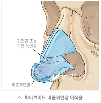 얼굴의 조화를 살린 JW정원성형외과 들창코, 짧은코 성형 관련 이미지 4
