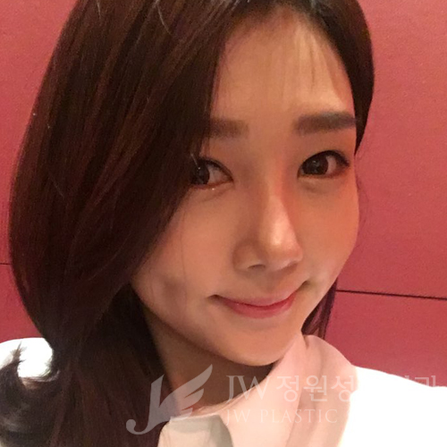 JW정원성형외과에서 매몰쌍꺼풀,앞트임,듀얼트임,코성형,넥리프팅으로 여신효과♡ 관련 이미지 15