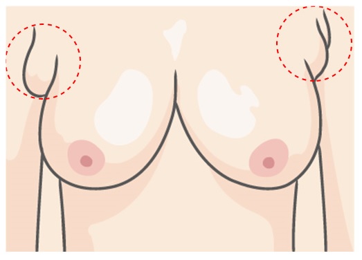 불룩 튀어나온 겨드랑이! JW정원성형외과 부유방 제거로 매끈하게 관련 이미지 2