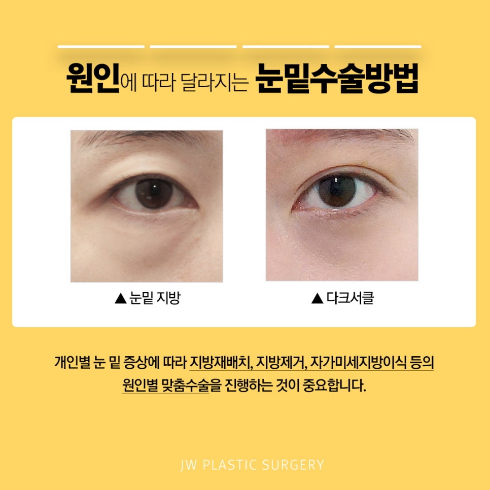 다크서클, 눈밑지방재배치로 탄력있는 동안 눈매 완성 관련 이미지 2
