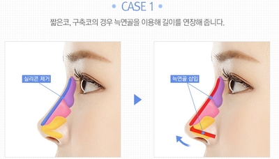 [JW Jeongwon Plastic Surgery] More Professional and Safer Rib Cartilage Rhinoplasty image 4