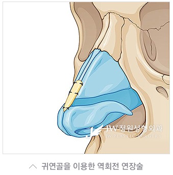 얼굴의 조화를 살린 JW정원성형외과 들창코, 짧은코 성형 관련 이미지 3