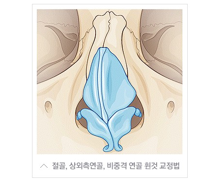 [JW정원성형외과] 코성형과 함께하는 비중격만곡증 및 비염수술 관련 이미지 3