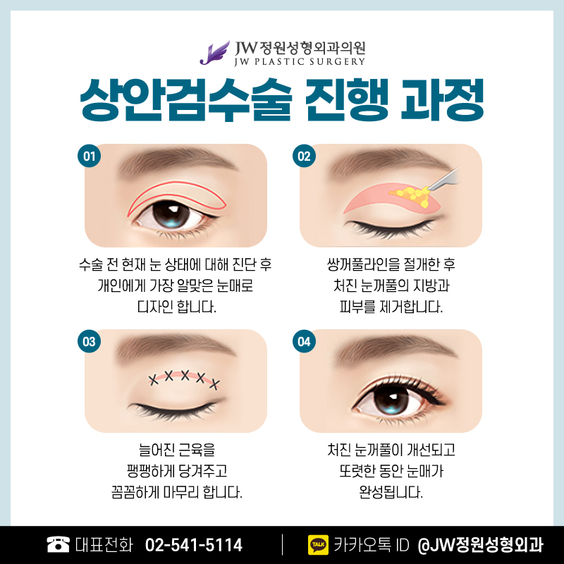 상안검후기 건강한 아름다움을 위해 【강남 JW정원성형외과】 관련 이미지 3