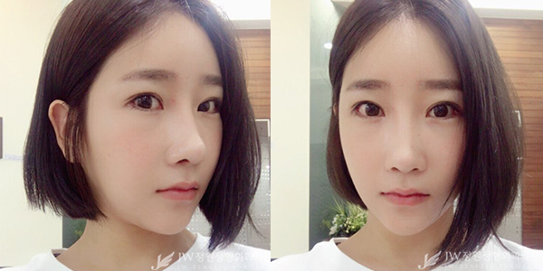 JW정원성형외과 눈+코성형으로 단아한 이미지 완성♡ 관련 이미지 2