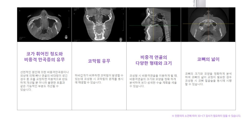 [JW정원성형외과] 코성형과 함께하는 비중격만곡증 및 비염수술 관련 이미지 7