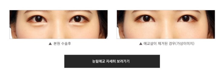 [JW정원성형외과] 눈밑지방재배치 핵심 기술력 관련 이미지 5